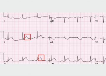 STEMI Interpretations